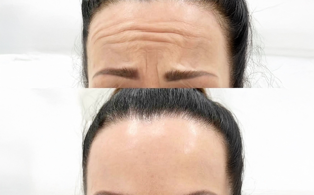 Anti-Wrinkle Injections